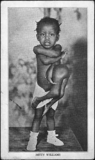 Betty Lou Williams, the girl with four legs and three arms