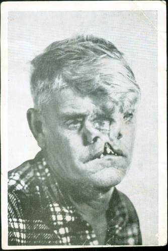 Bill Durks, The Man with Three Eyes and Two Noses